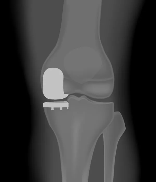 Partial-Knee-x-ray-post-op