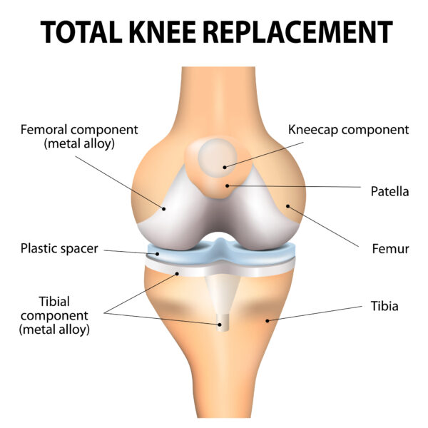 Total-Knee