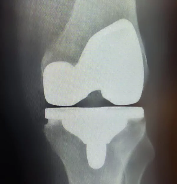 Total-Knee-pot-op-x-ray-2