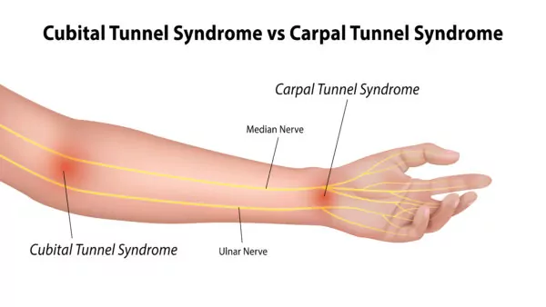 Upper-Extremity-Nerves-Carpal-vs-Cubital-Graphic