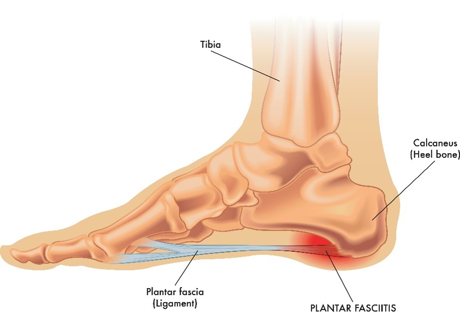 Plantar Fasciitis anatomy useful to learn how to treat plantar fasciitis and techniques used in physical therapy for Plantar Fasciitis