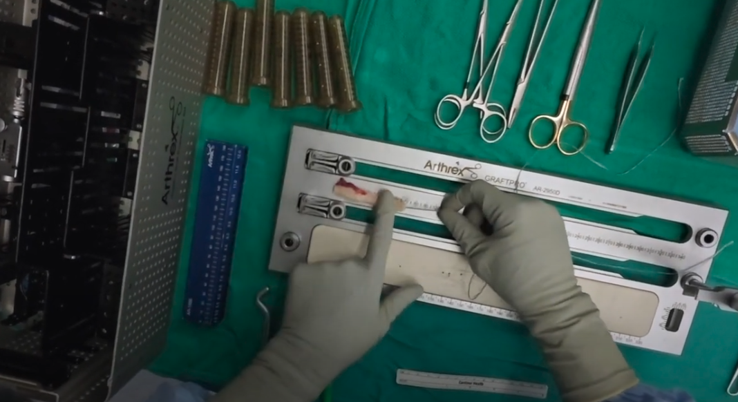 ACL Reconstruction Graft Harvest to help repair an ACL Tear. Performed by Dr Craig Yager