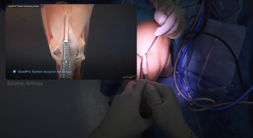 ACL Reconstruction Graft Harvest to repair an ACL Tear with Dr Craig Yager